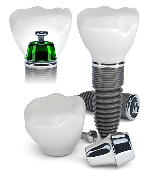 dental implants 08902