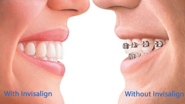 invisalign 08902